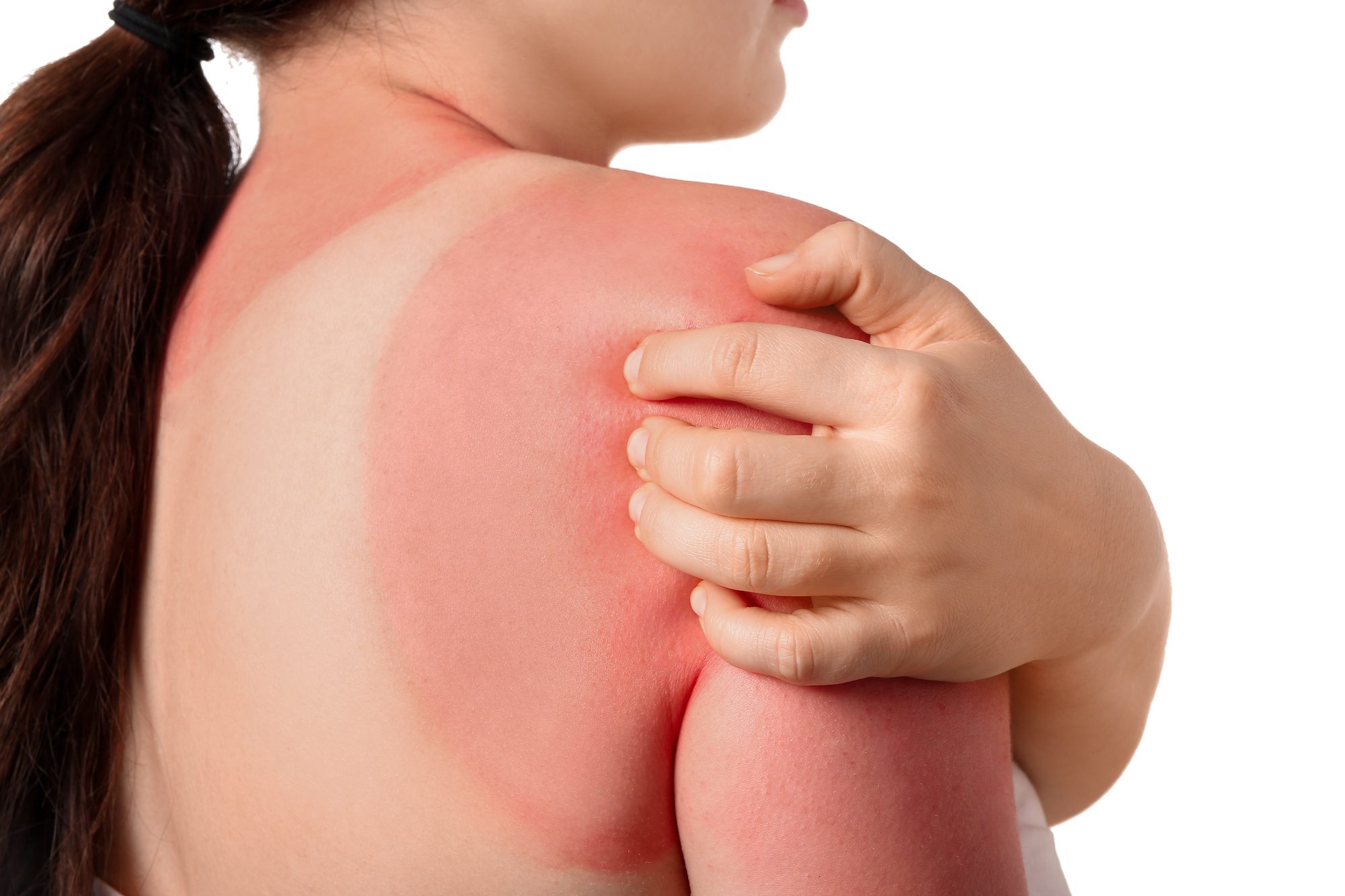 Dermatolgie-Ratschläge-Sommer-Sonnenbrand